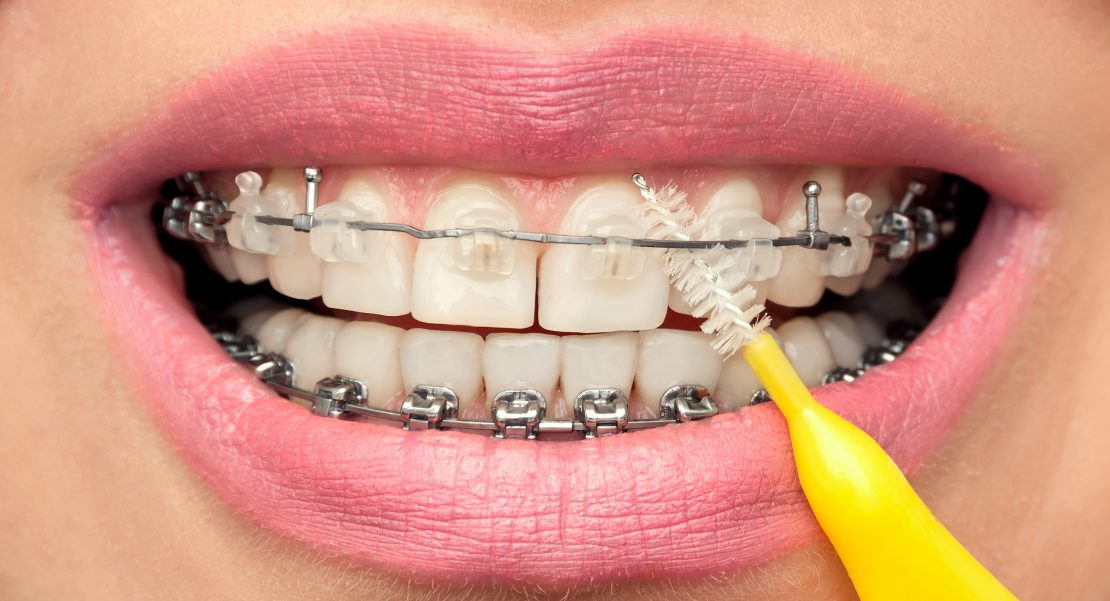higiene dental con brackets