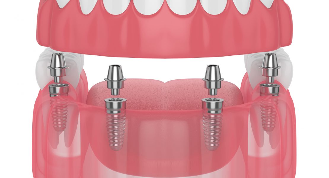 sobredentadura sobre implantes