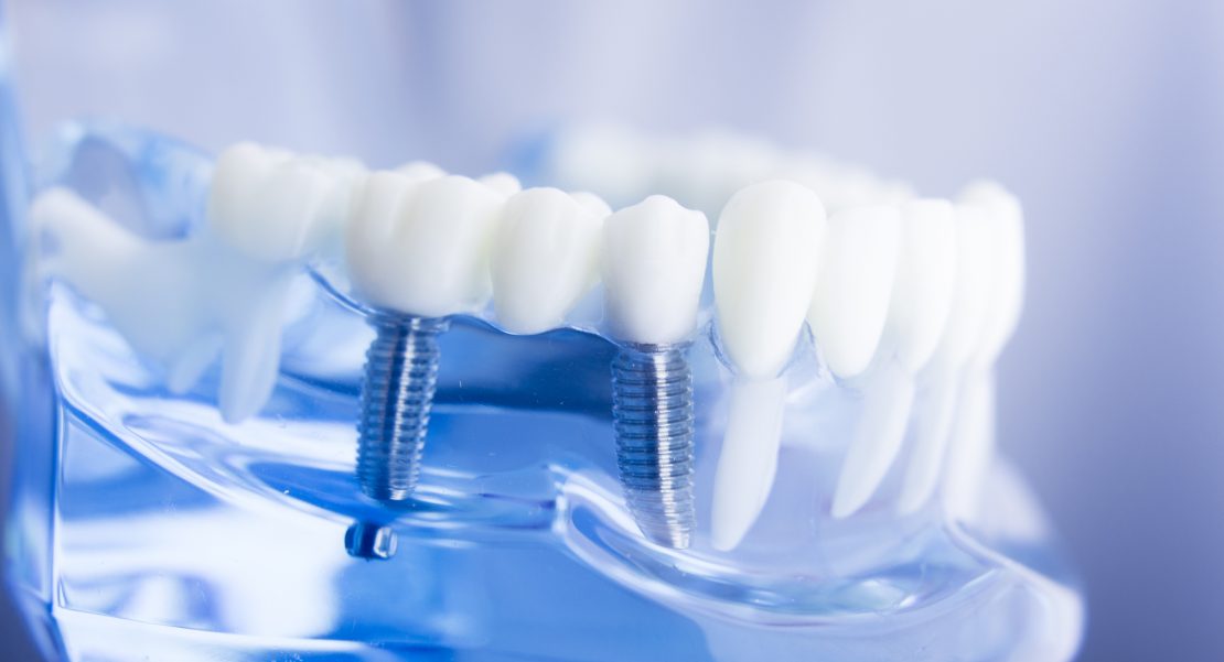 tipos de implantes dentales