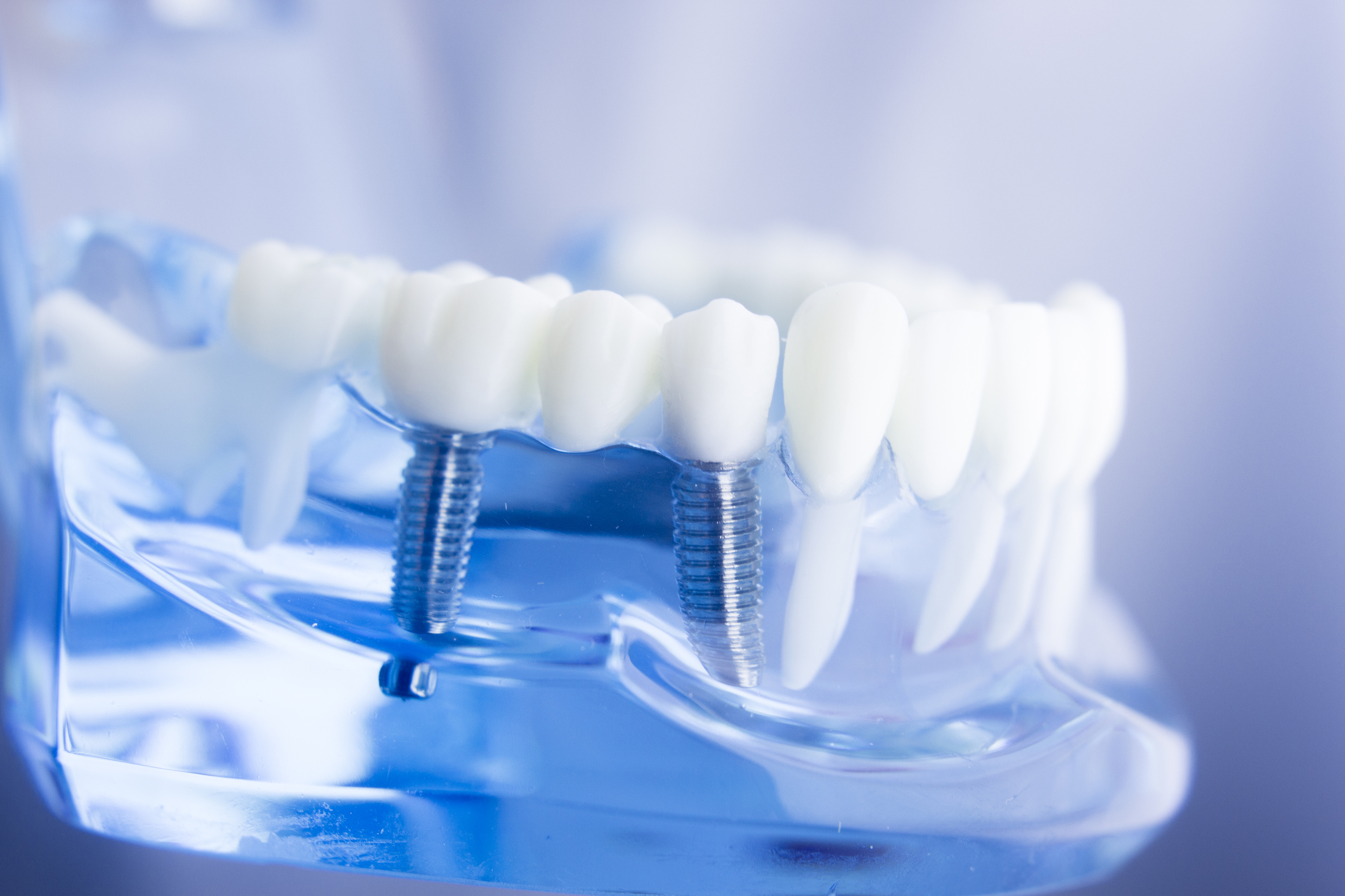 tipos de implantes dentales