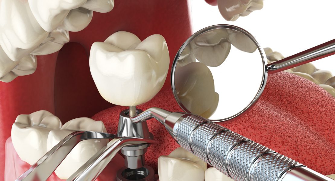 dudas sobre implantes de carga inmediata