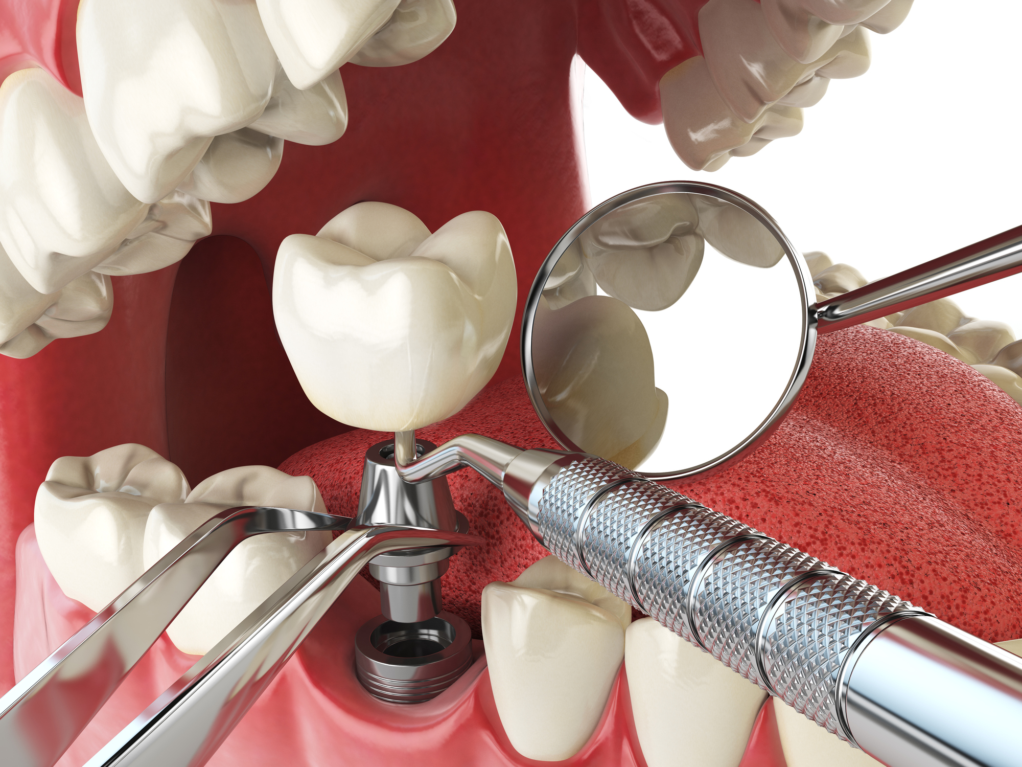 dudas sobre implantes de carga inmediata