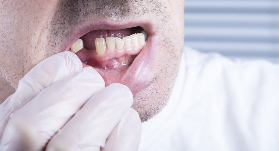 pérdida de piezas dentales