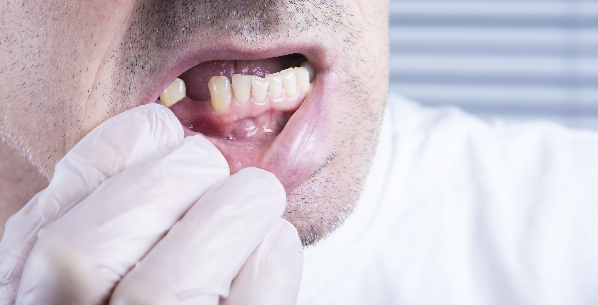 pérdida de piezas dentales