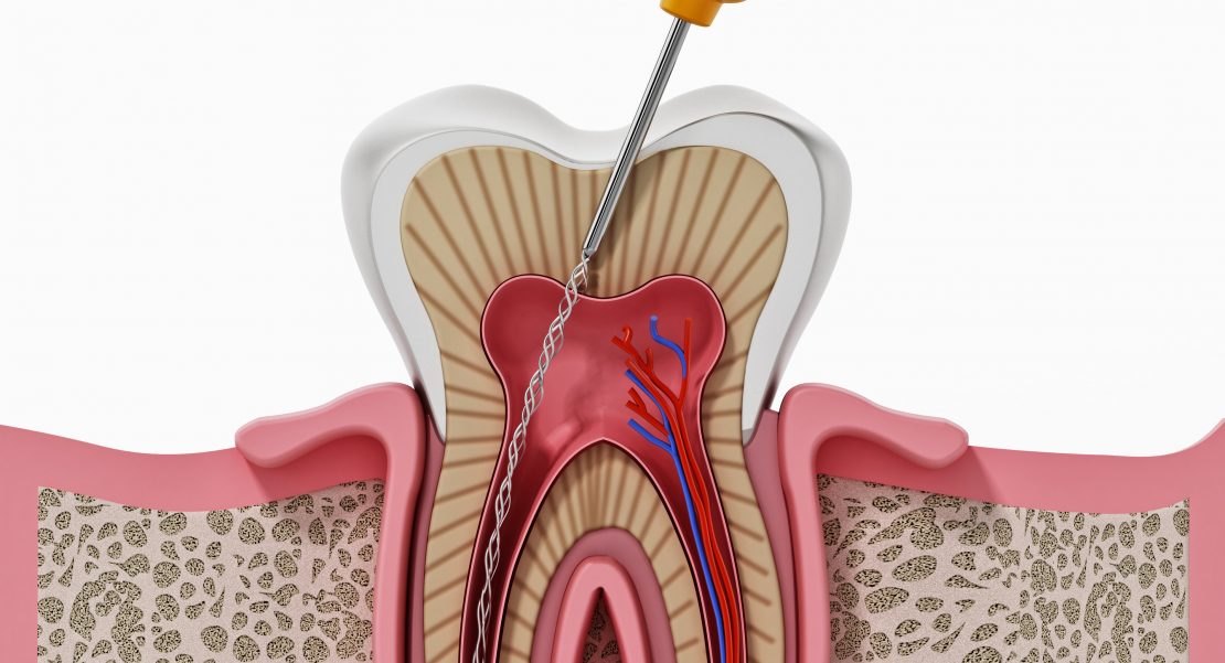 Tratamiento de endodoncia.