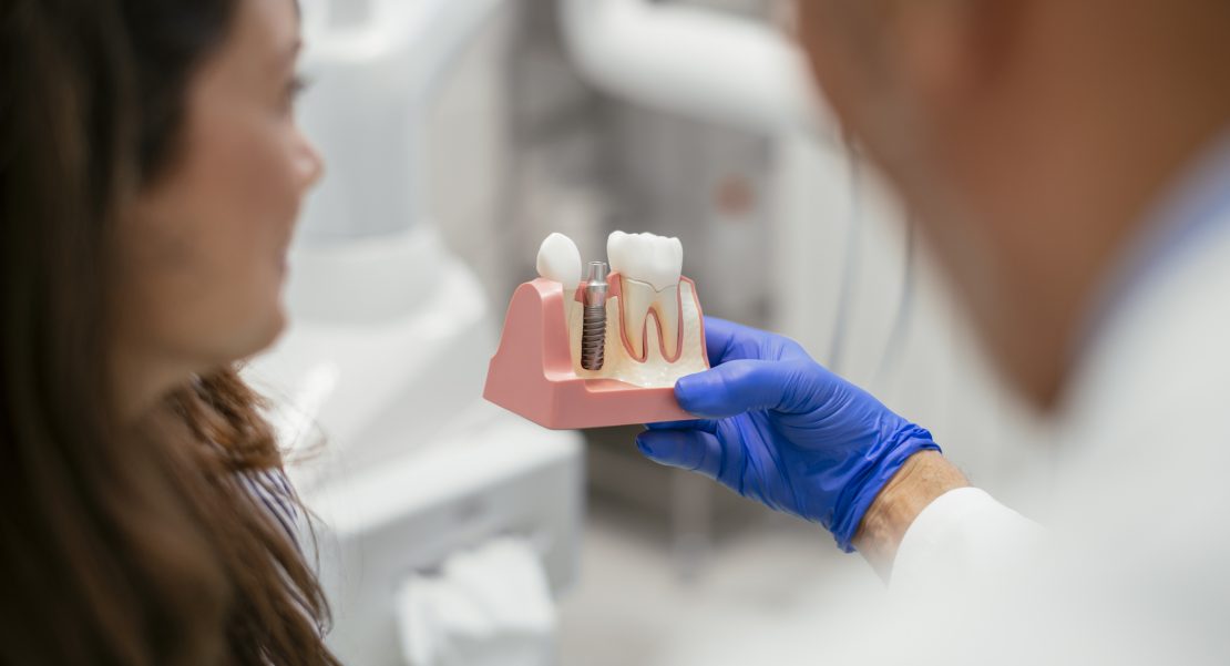 implantes dentales