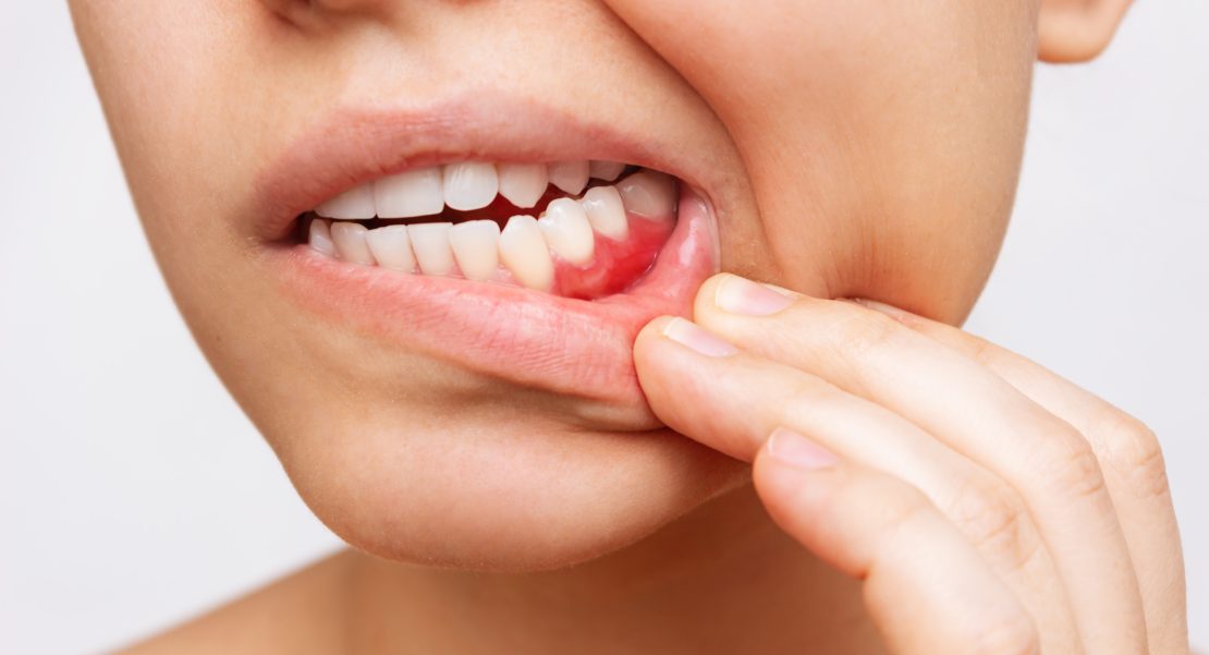 enfermedades periodontales