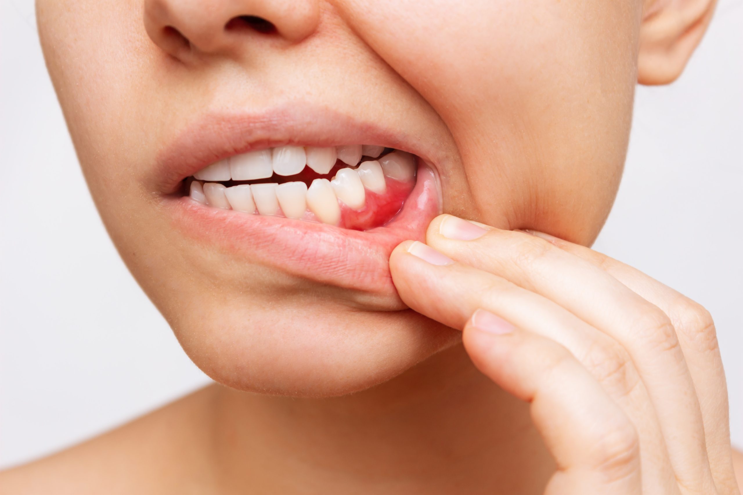 enfermedades periodontales