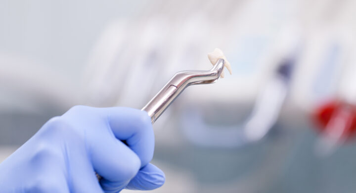 pérdida dental