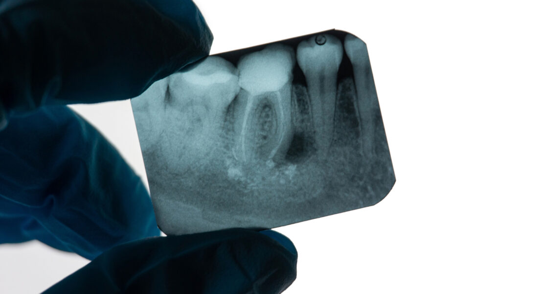 endodoncia