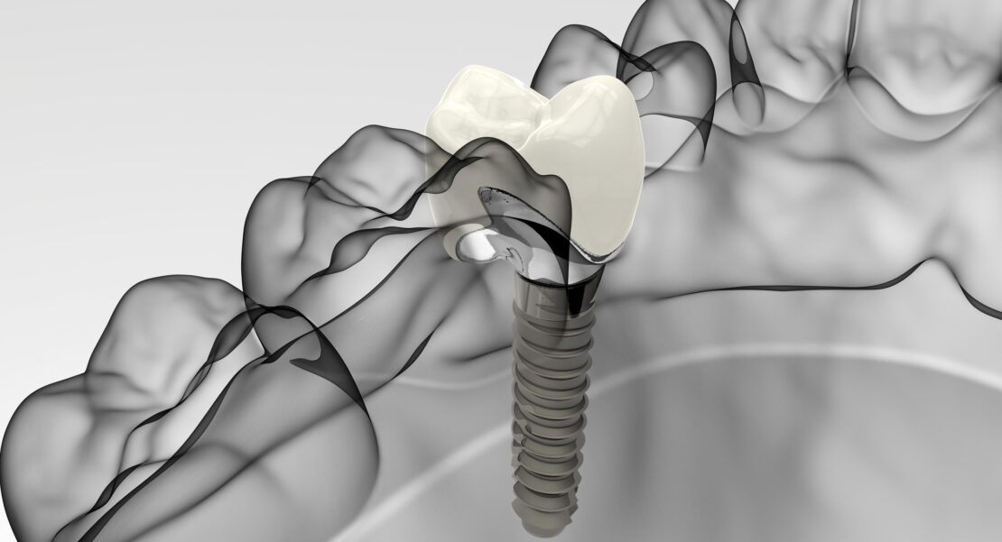 implantes dentales